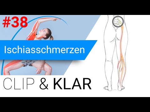 Ischiasschmerzen erklärt - Nervige Schmerzen im Bein