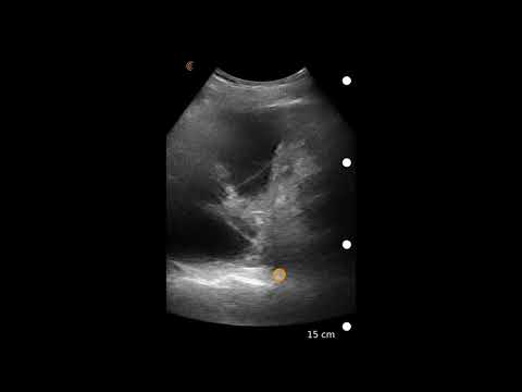 Image Interpretation: Pleural Effusion