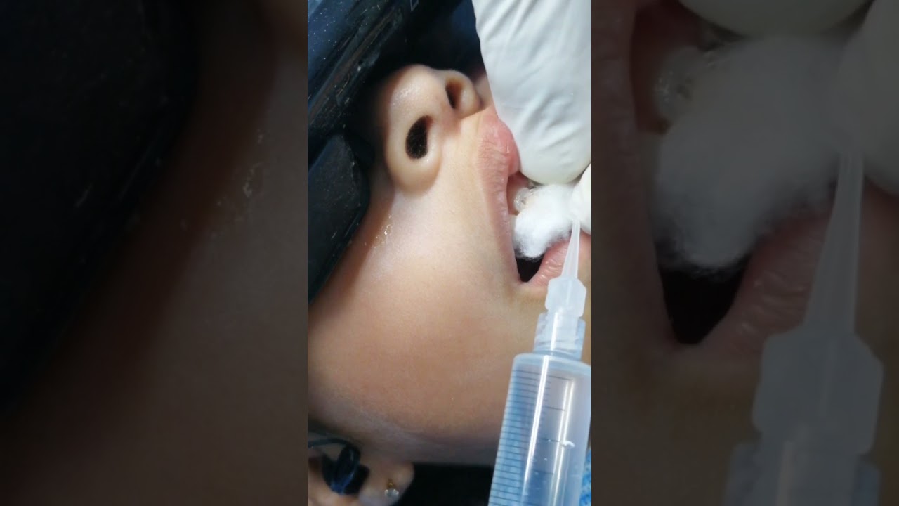 Watch Endodoncia y Corona de Zirconia en Niños Now Endodoncia y Corona de Zirconia en Niños