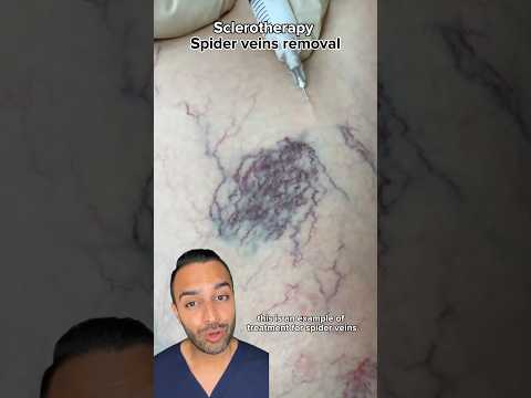 Removing Spider Veins With Sclerotherapy Treatments | Dr. Somji Explains