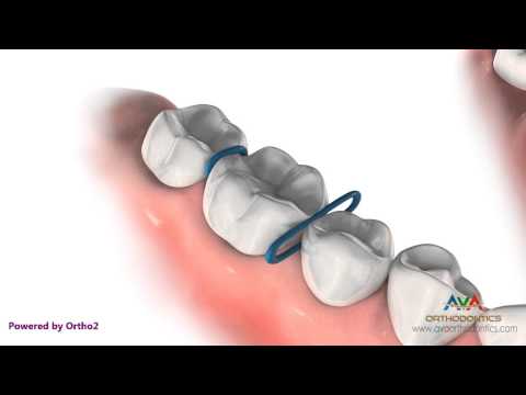 Orthodontic Separator or Spacer - Rubber O-Rings