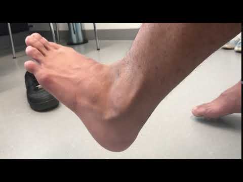 Peronealsehnen-Luxation Ansicht von dorsolateral