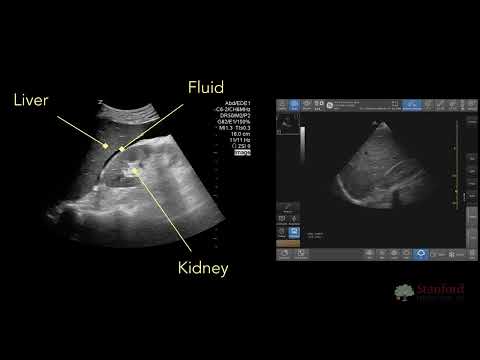 Point of Care Ultrasound for Ascites (POCUS)