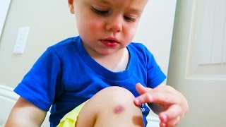 FIRST SPIDER BITE/ HE IS ALL BETTER!