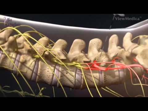 osteocondroza spondilartrozei discului a arcadelor