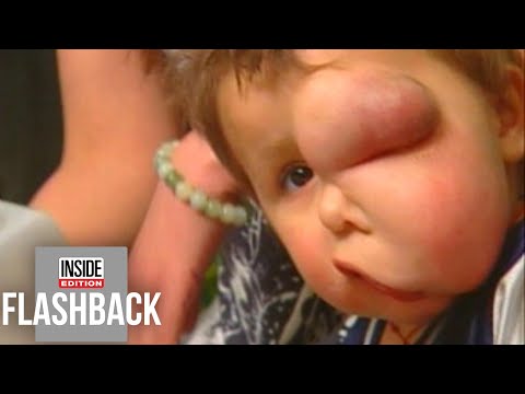 How Toddler’s Life Was Saved by Having Facial Tumor Removed