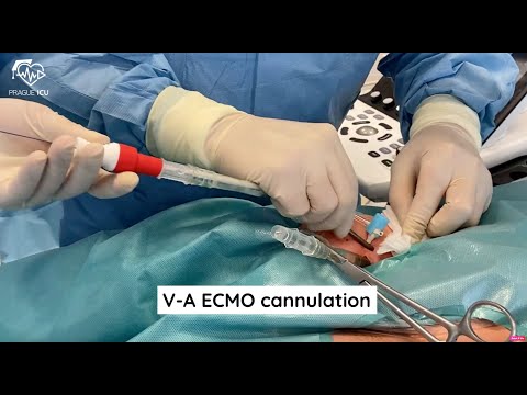 ECMO cannulation