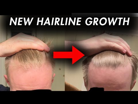 Hair Loss Recovery in 1 Year:  Hairline Regrowth