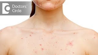 What causes body acne? - Dr. Aruna Prasad