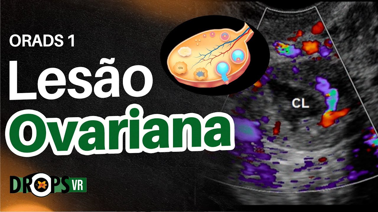 ORADS 1 - COMO PROCEDER FRENTE A UMA LESÃO OVARIANA | VOCÊ RADIOLOGISTA