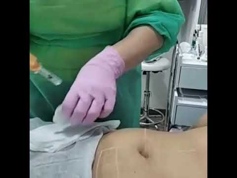 Tratamiento con Hyaluron Pen -mesoterapia corporal.