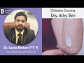 Oops!! Dry, Itchy Skin in Diabetes- Know Why ??? Causes, Symptoms, & Treatment-Dr. Leela Mohan P V R