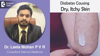 Oops!! Dry, Itchy Skin in Diabetes- Know Why ??? Causes, Symptoms, & Treatment-Dr. Leela Mohan P V R