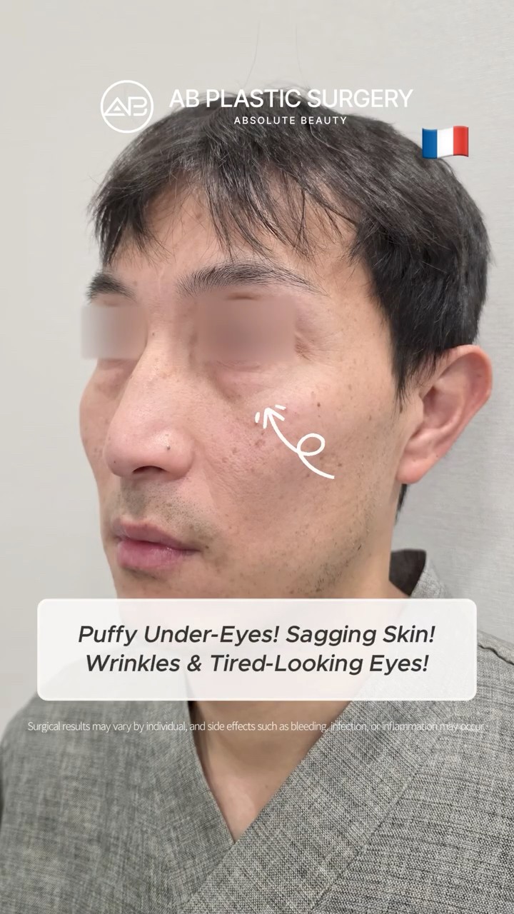 Look Younger: Lower Blepharoplasty & Fat Grafting
