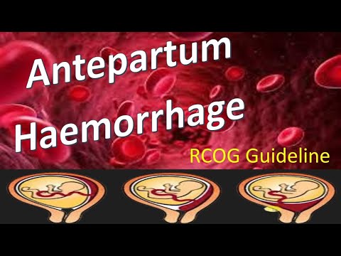 Antepartum Haemorrhage | RCOG Guideline