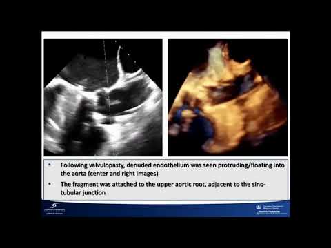 TAVR Complication Surprise - Susheel Kodali, MD