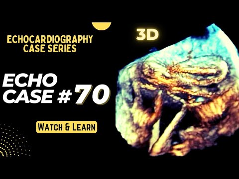 Echocardiography Case 70: Echo Spot Diagnosis Series - Cardiology