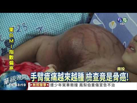 手臂腫如籃球 檢查竟是骨癌