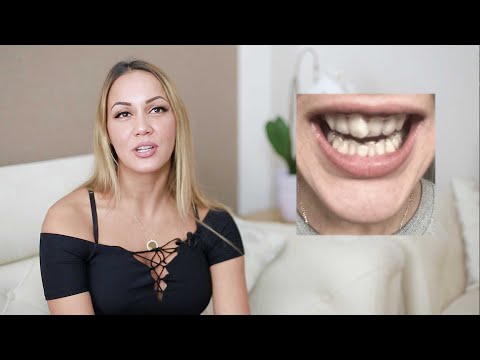 DR SMILE Stories: Zahnfehlstellung - Aylins Erfahrungen