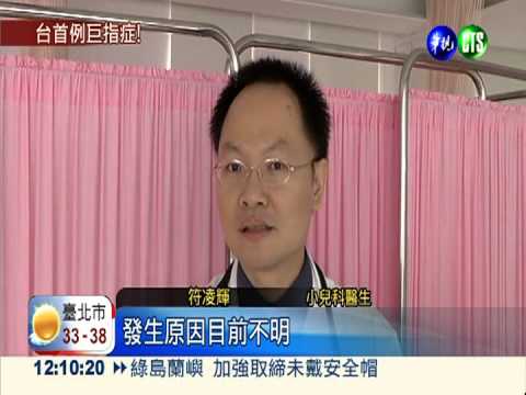 罕見! 1月嬰右指比左指大1.5倍