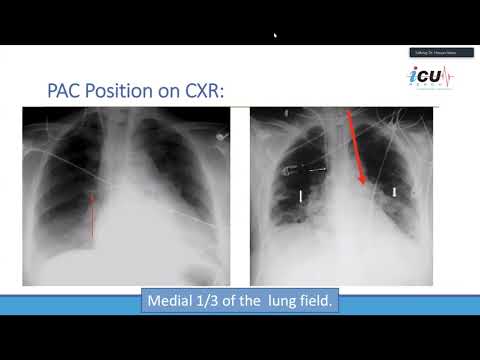 Advanced Invasive Hemodynamic Monitoring