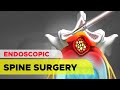 Endoscopic Spine Surgery: The Unilateral Biportal Endoscopic (UBE) Technique