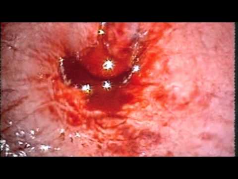 Il cancro alla prostata è contagioso Trattamento prostatite di canfora
