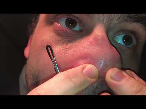 Mitesser (Komedonen, Blackhead) entfernen mit Komedonenheber (Komedonenquetscher) Anleitung