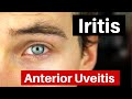 Iritis - What is Anterior Uveitis? Doctor Explains
