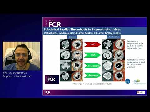 Challenges and opportunities in high-risk patients undergoing TAVI - EuroPCR 2021