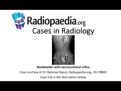 Neobladder with vesicoureteral reflux (Radiopaedia.org) Cases in Radiology