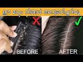 താരൻ മാറികിട്ടാൻ ഏറ്റവും എളുപ്പത്തിൽ ഒരു മാർഗ്ഗം #short#shortvideo