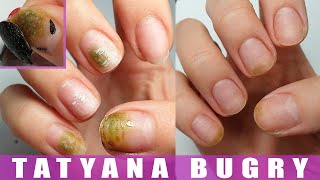 How I Cured My Nails | Shocking Experience | Restoring Nails from Bacteria