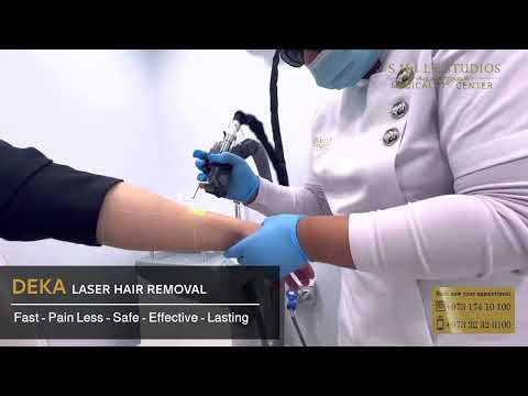 Splendor X LASER HAIR REMOVAL | DEKA LASER HAIR REMOVAL