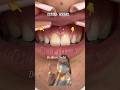 SMALL TEETH…Lateral PEG Shaped #bobmarley #music #shorts #viral #trending #smile#youtubeshorts #fyp