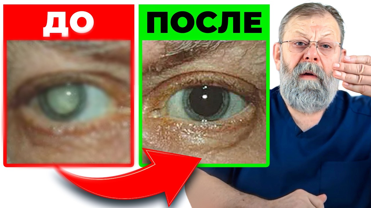 Cataracts. 99% of people don't know this 1 exercise!