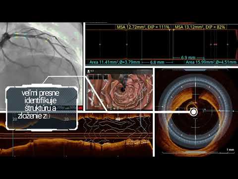 CINRE - OCT optická koherenčná tomografia