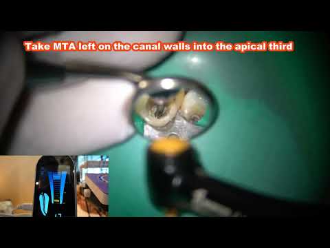 812MT used to condense MTA in the maxillary right central incisor/812MTを上顎前歯のMTA根管充填に使用した症例