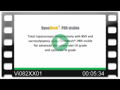 DynaMesh®-PRR - OR-Video: Total Lap. Hysterectomy w. BSO and Sacrocolpopexy