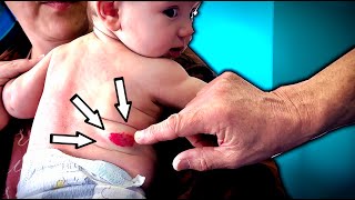 HEMANGIOMAS & BABIES... (What Parents Need to Know) | Dr. Paul “Retired”