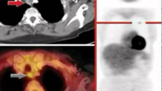 Understanding Esophageal Cancer, Part III:  Staging