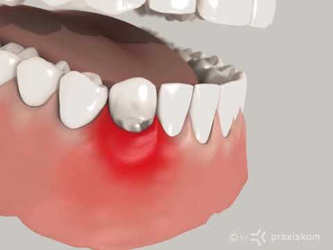 Parodontosebehandlung