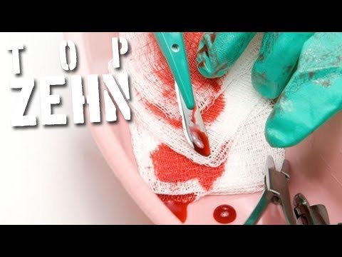 Atmosphärendruck und ist hypertensive Hypertension ii Grad.
