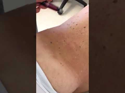 Se la tachicardia può essere in osteocondrosi seno Tipo di giunto 1a-norm