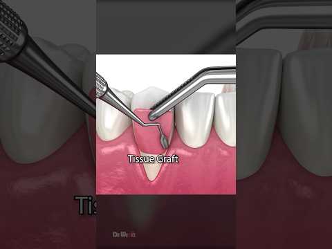 Soft Tissue Graft Surgery for Receding Gums