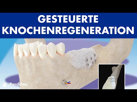 Gesteuerte Knochenregeneration ©