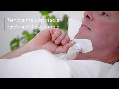 Using Genio as the CPAP alternative for Obstructive Sleep Apnea