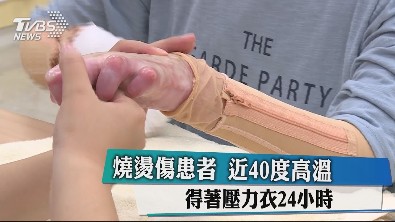 燒燙傷患者煎熬 夏季高溫得穿著壓力衣