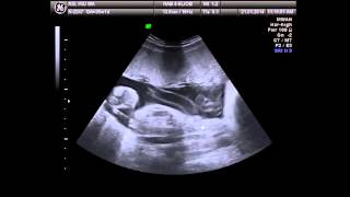 Pregnancy 8 months baby, ultrasound