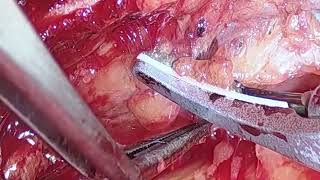 Asvide: Precise dissection is done using open-shear mode and blunt dissection is done using...
